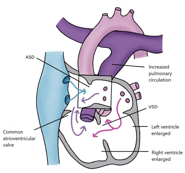 Atrioventricular Septal Defect, AVSD - Sydänlapset ja -aikuiset ry